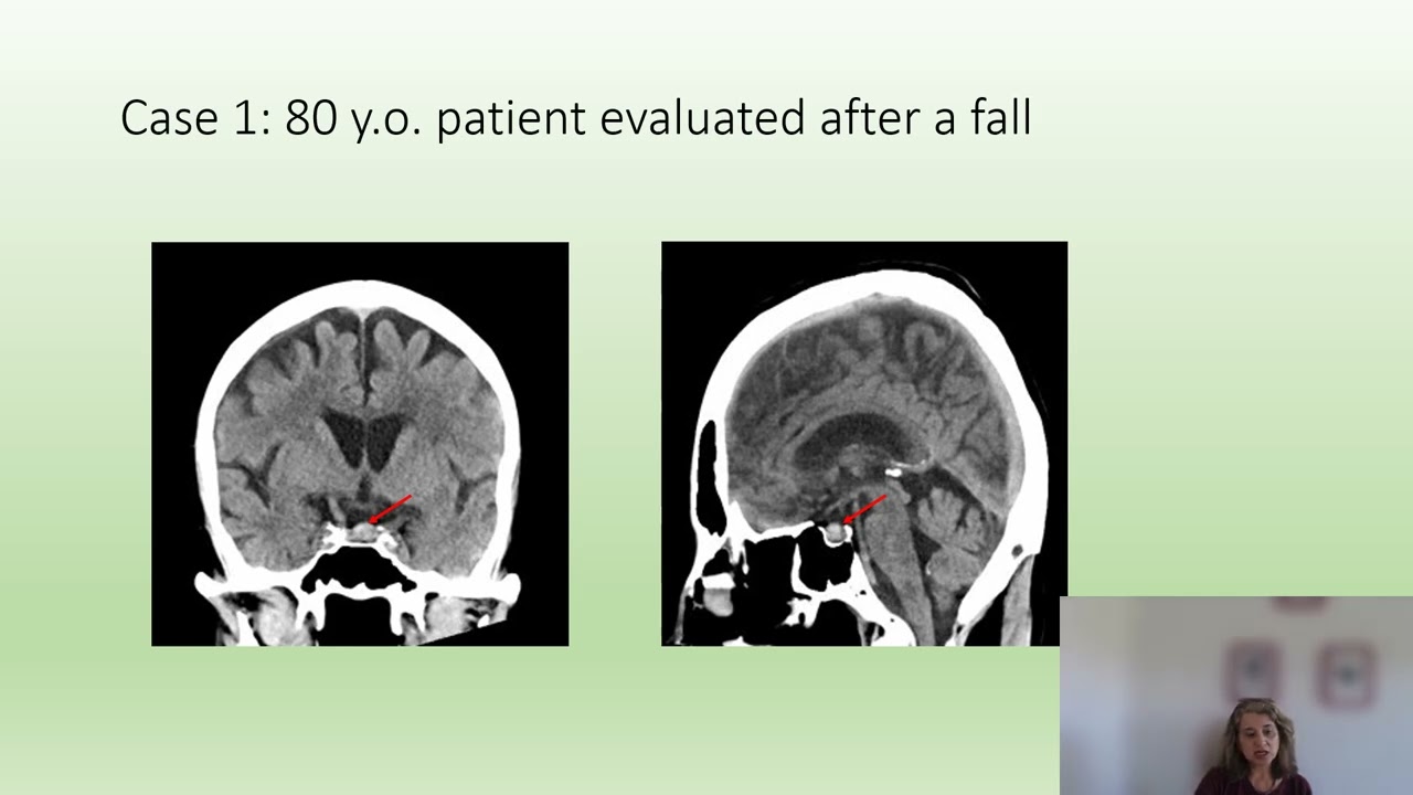Pituitary Incidentaloma Webcast
