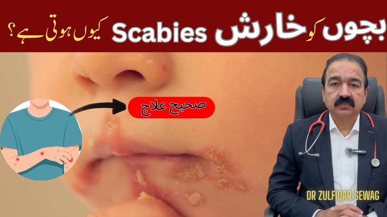 Why Do Children Get Scabies ? Causes, Symptoms & Treatment Explained