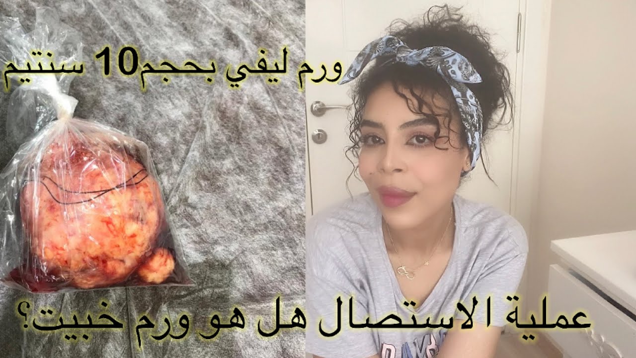 تجربتي مع الاورام الليفية في الرحم(الفيبروم) بعد عامين من استاصله +نصايح لكل امراة مصابة بالمرض