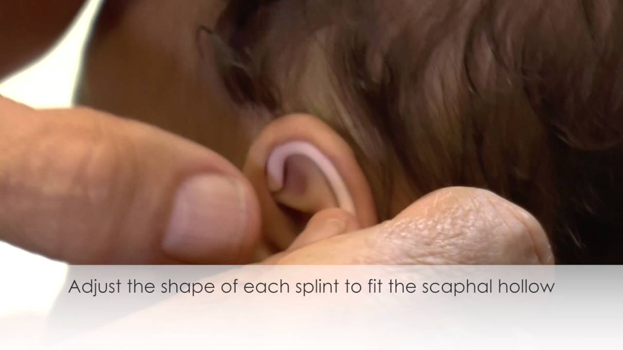 Adjusting the Splint - EarBuddies Tutorial