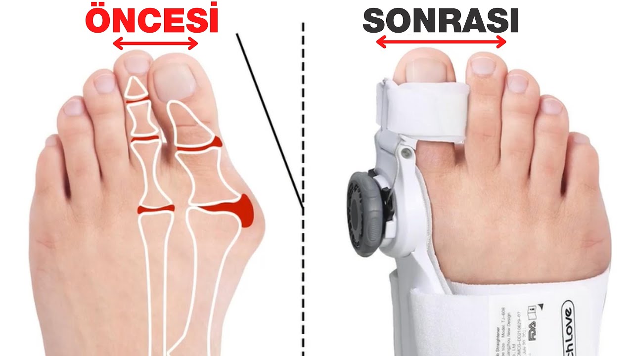 Ayak Başparmak Kemik Çıkıntısı Nasıl Düzeltilir ? Halluks Valgus Ateli