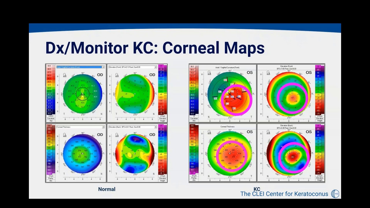 Corneal Collagen Crosslinking for Keratoconus 2/21/2020