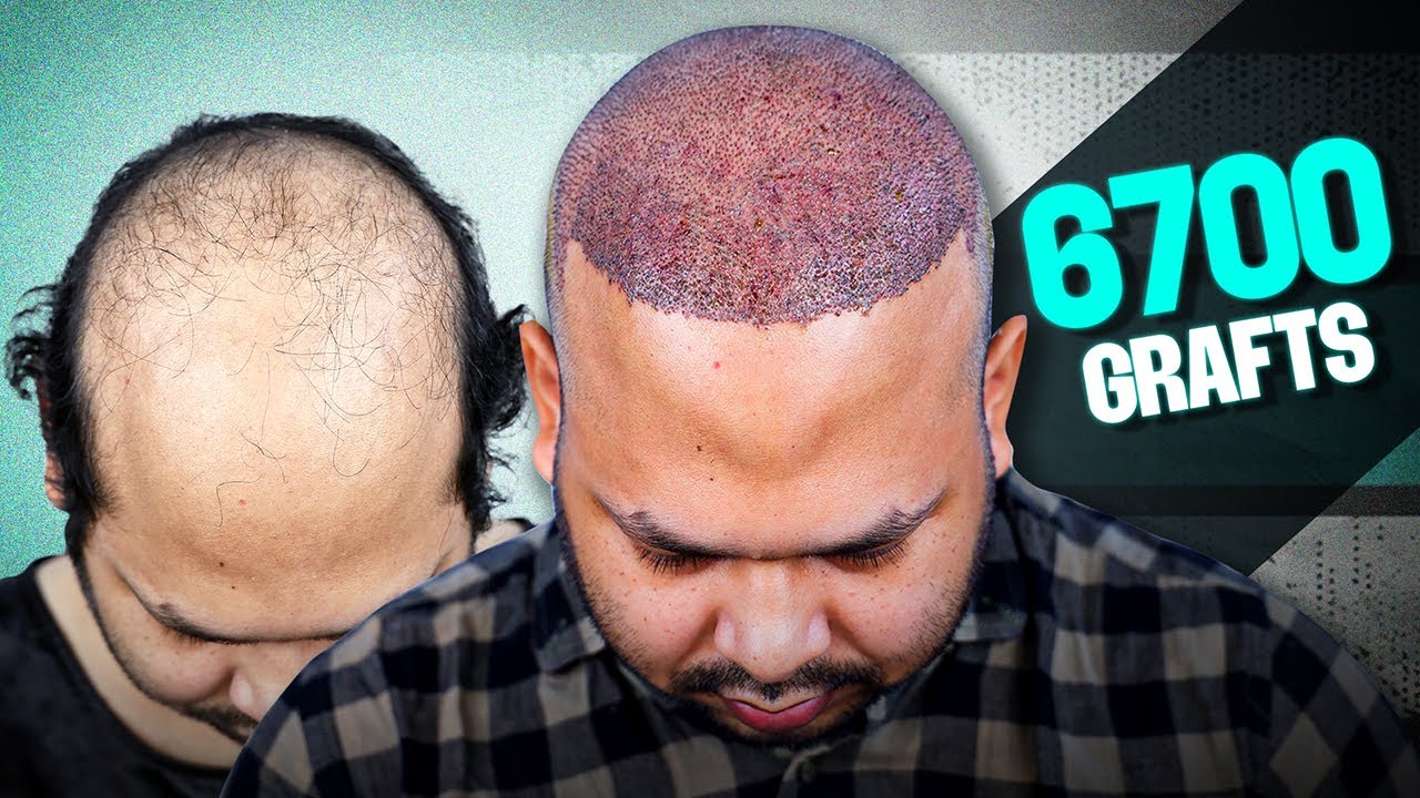Case Study of Grade 7 Baldness 😊 | Hair Transplant in Bangladesh | New Roots