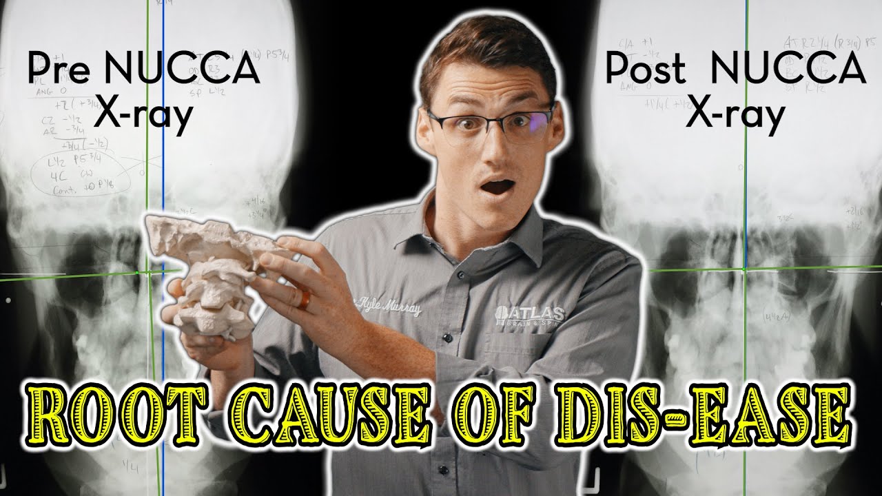 The Atlas Subluxation Complex (ASC) Explained: Your Body's Sneaky Saboteur