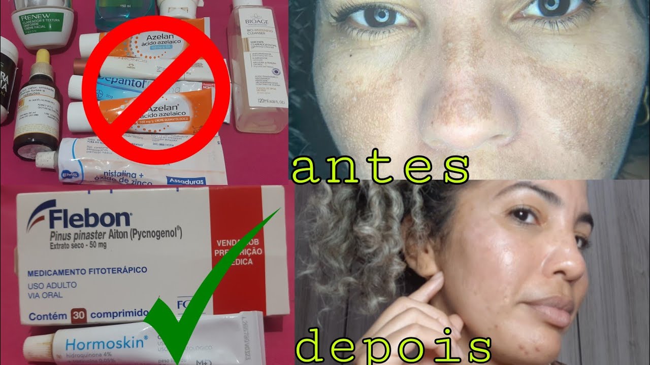MELASMA como clarear /como clarear melasma no rosto/ tratamento com hormoskin pra melasma