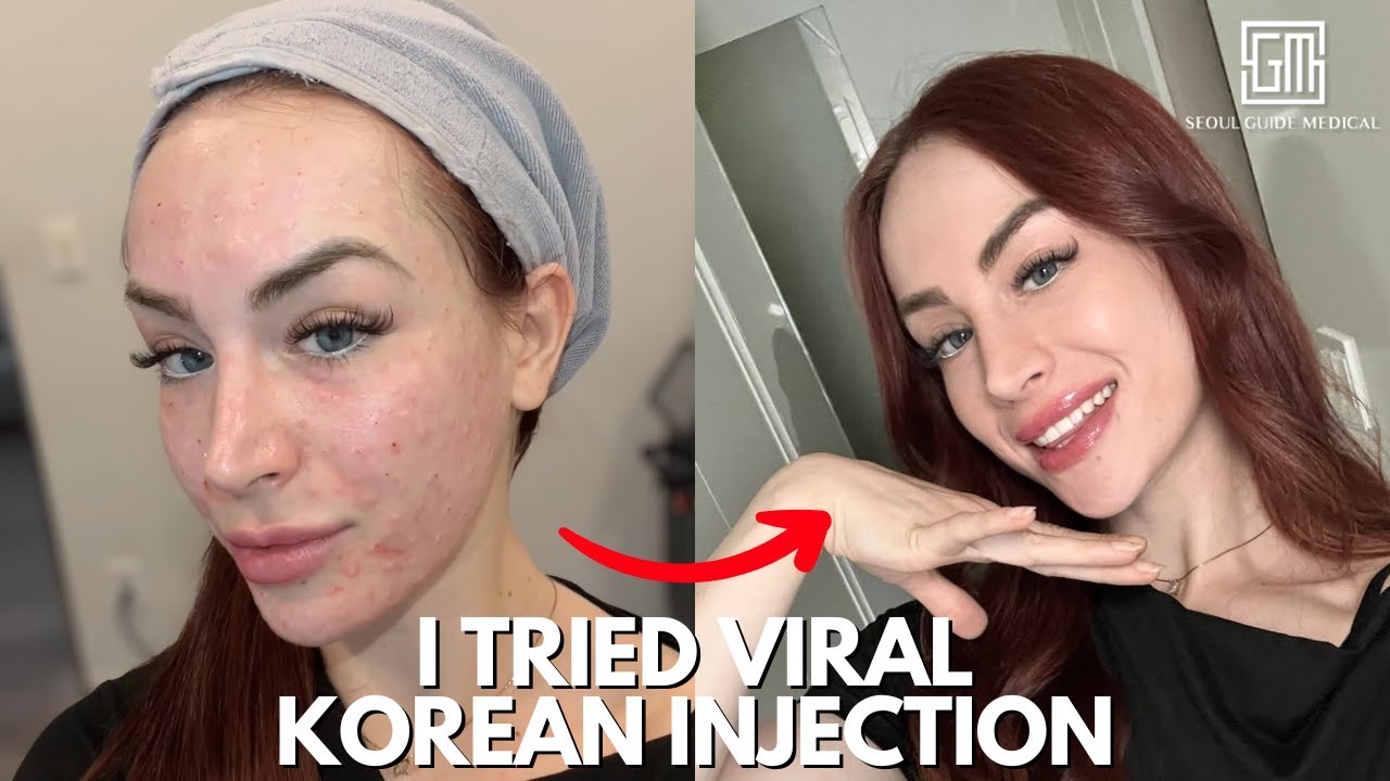 We Tried Korea’s Famous Goddess Injection | Stem Cell Glass Skin Treatment with SGM