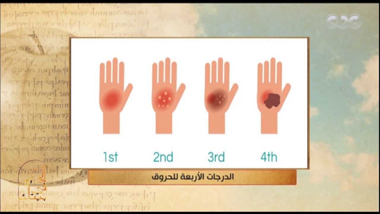 الحكيم في بيتك| د.فتحي خضير يوضح طرق علاج الحروق بجميع درجاته
