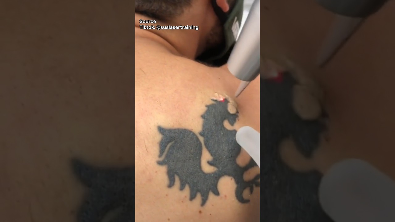 Bagaimana Cara Tato Dihapus?