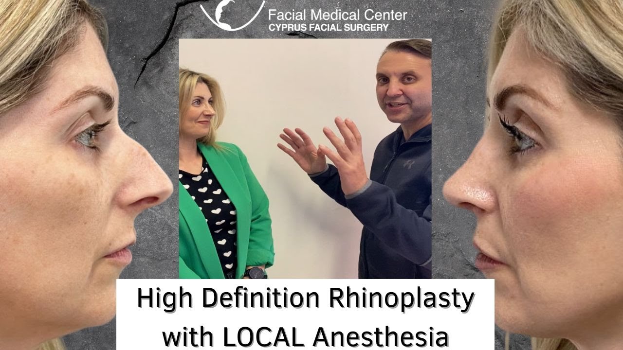 High Definition Rhinoplasty with LOCAL Anesthesia |CFS