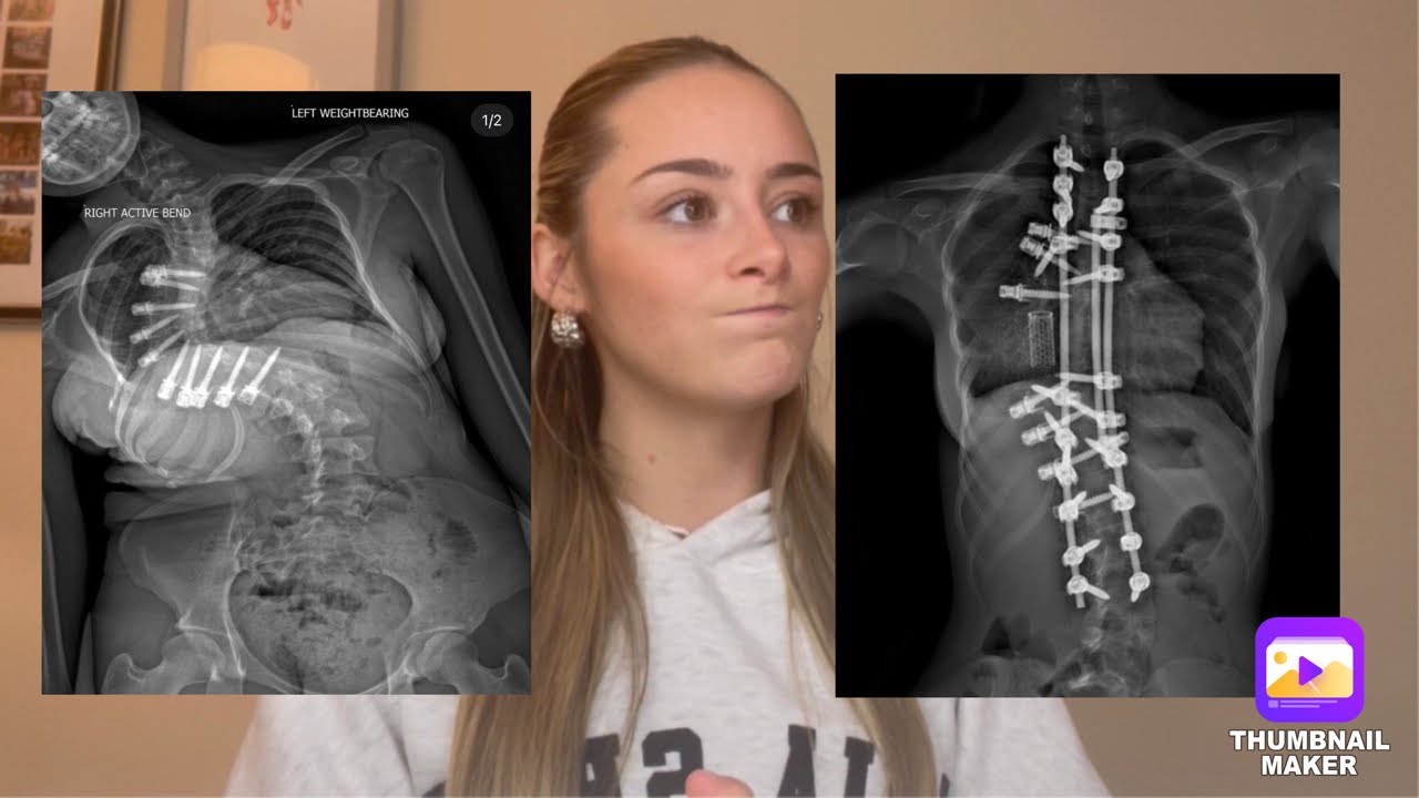 1 YEAR POST OP UPDATE - Scoliosis Surgery