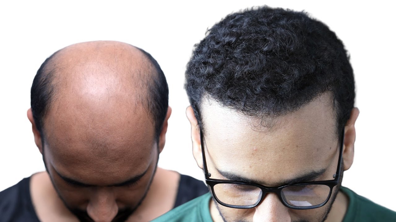 Completely Bald Person Gets Full Hair After Hair Transplant