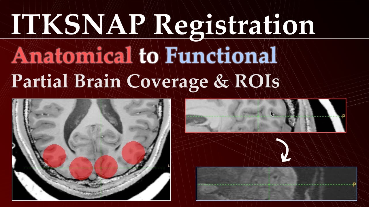 Tutorial - Register anatomical to functional data for partial brain coverage