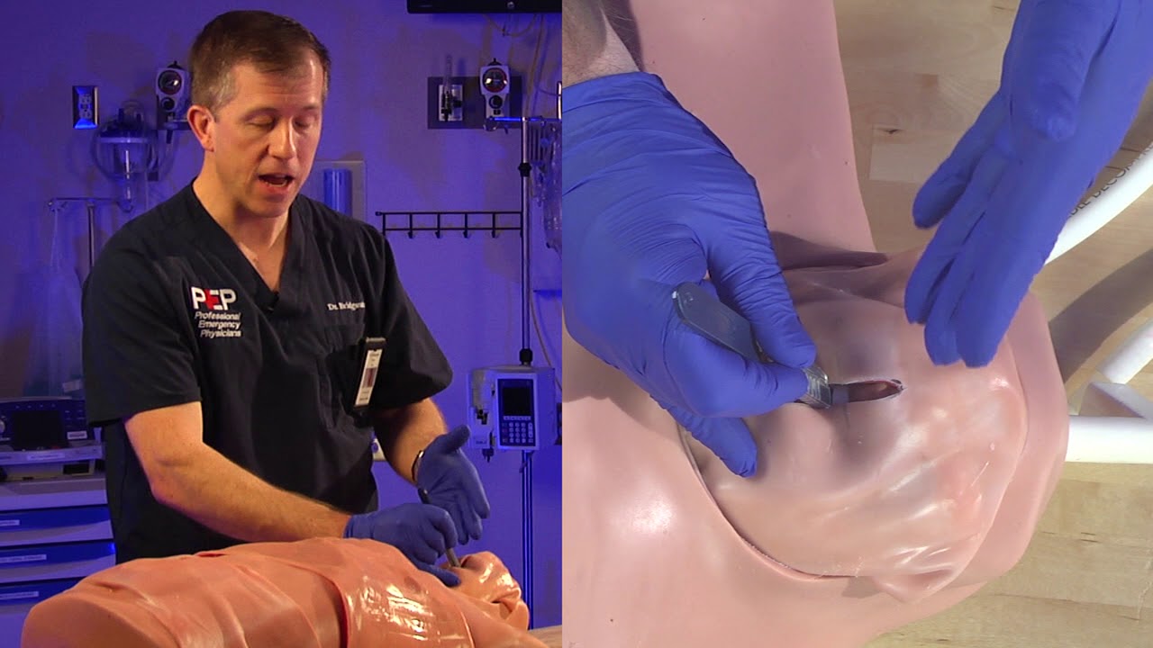 Emergency Bougie Cricothyrotomy Procedure Explained