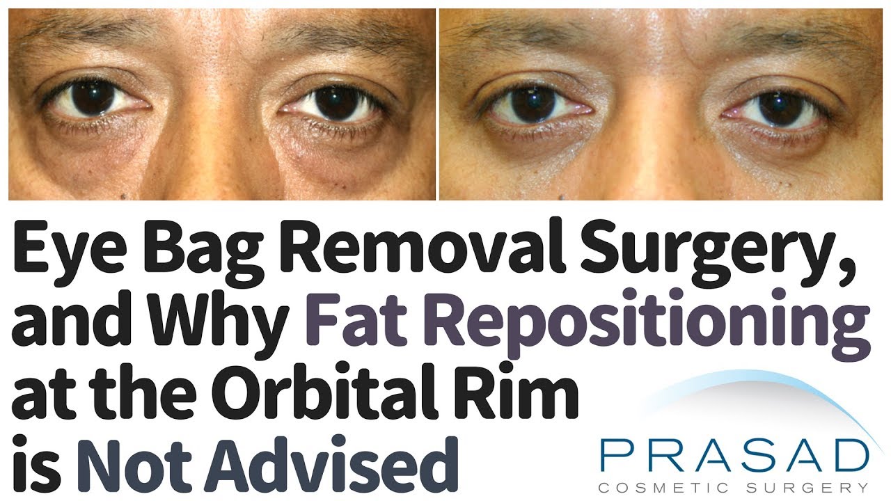 How Lower Eyelid Surgery can Help with Puffy Eye Bags, but Fat Repositioning Should be Cautioned