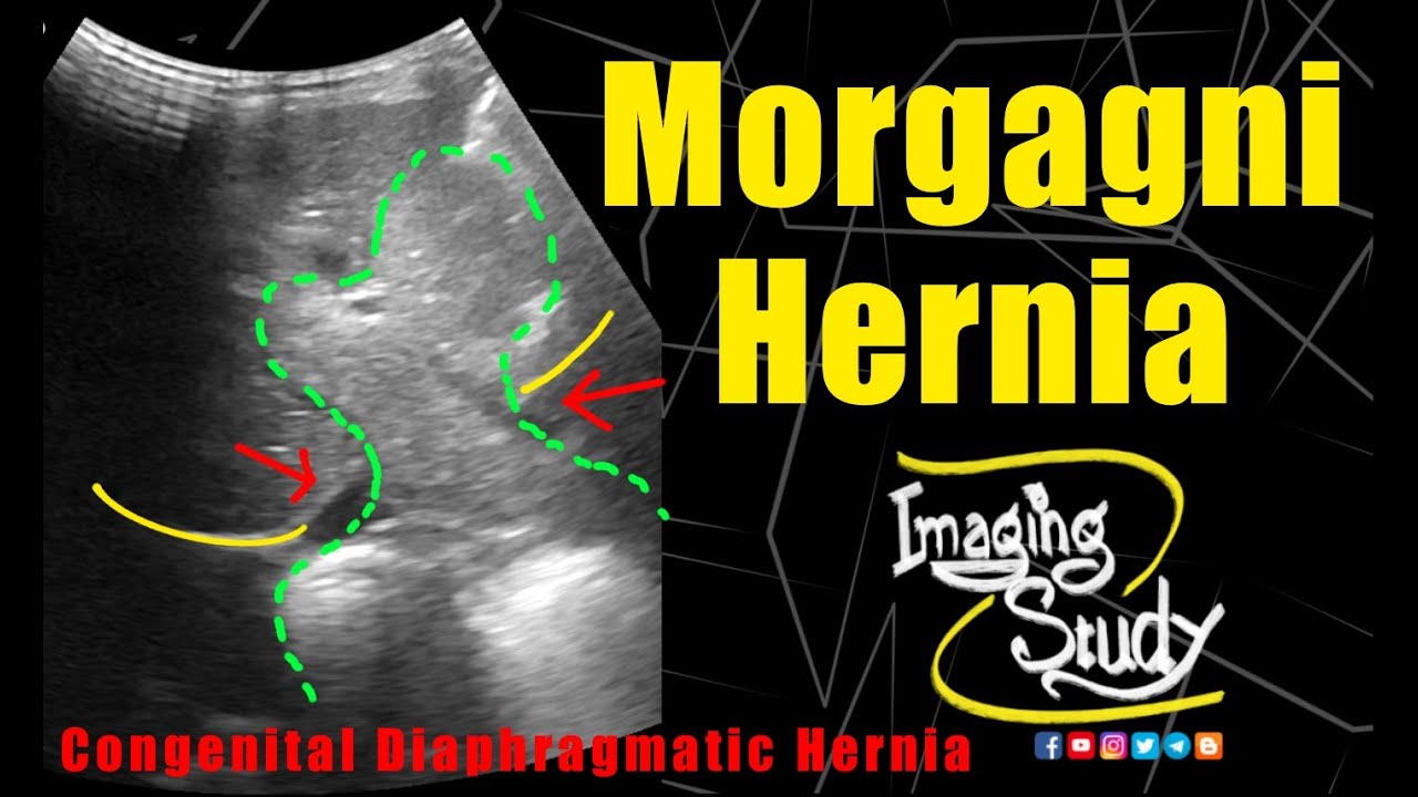 Morgagni Hernia || Congenital Diaphragmatic Hernia || Ultrasound || Case 270