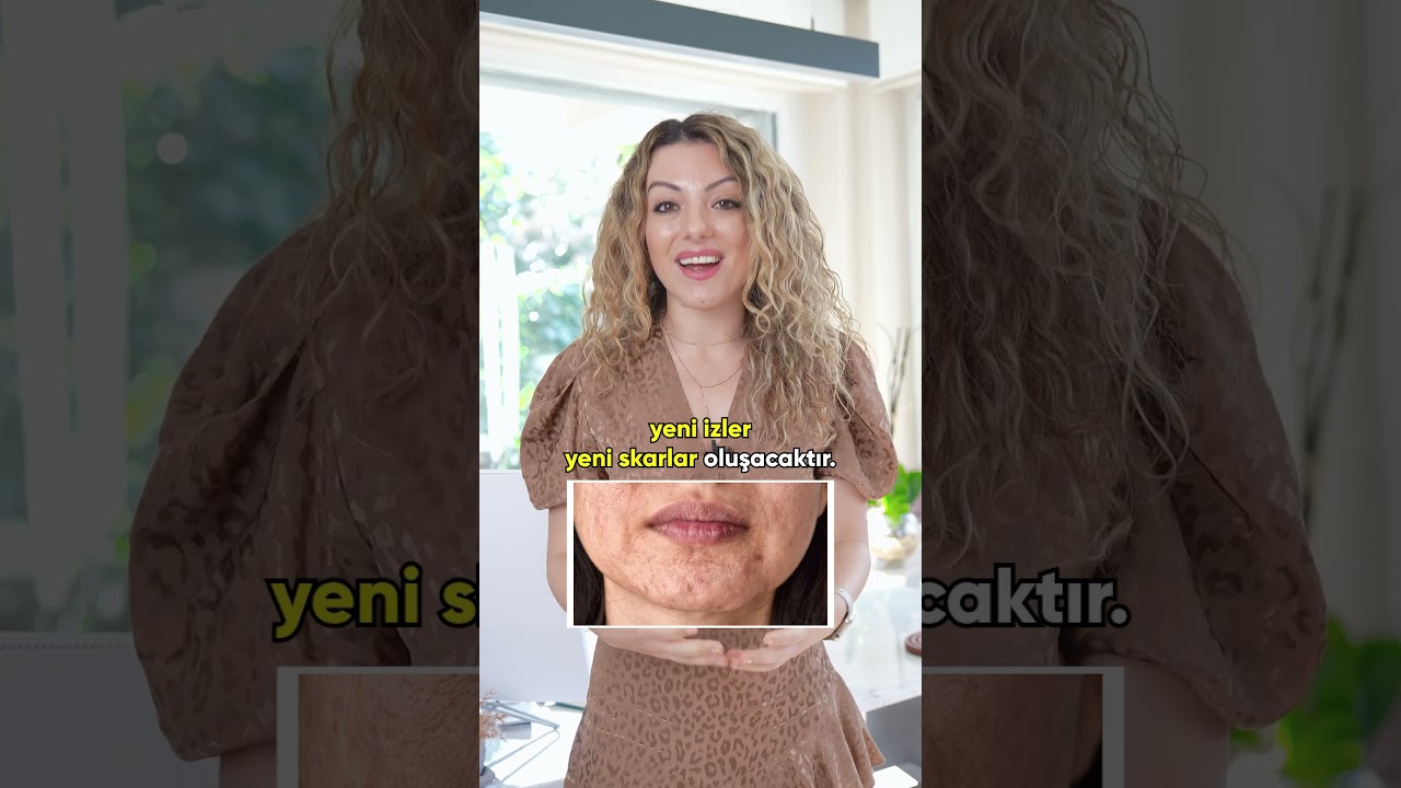 Akne Tedavisinde En &Ouml;nemli Şey - Sivilcelerle Savaş!