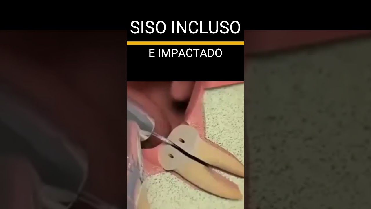 DENTE SISO #shortsvideo  #dentista #dentes #shortsfeed #odontologia #resumosdeodonto #dentist#dosiso