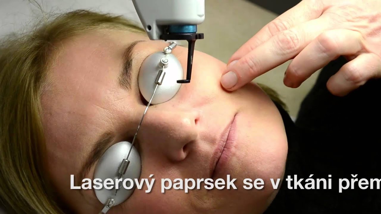 Laserové odstranění žilek - BcD clinic
