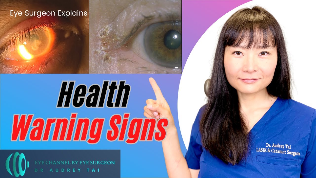 DO NOT Miss - Warning Signs in Your Eyes - Nutritional Deficiencies | Eye Surgeon Explains