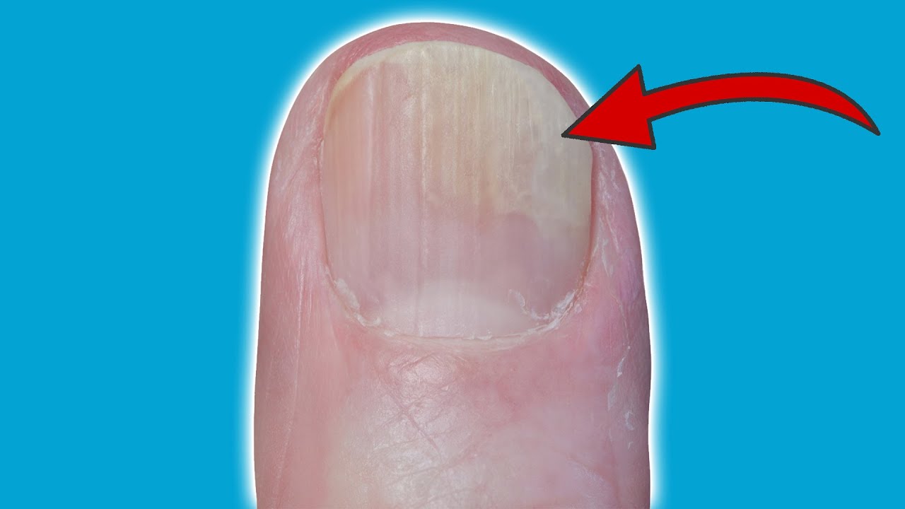 DIESE 5 Nagelprobleme lassen sich mit Hausmitteln beseitigen 💥 (EXTREM einfach) ⚡️