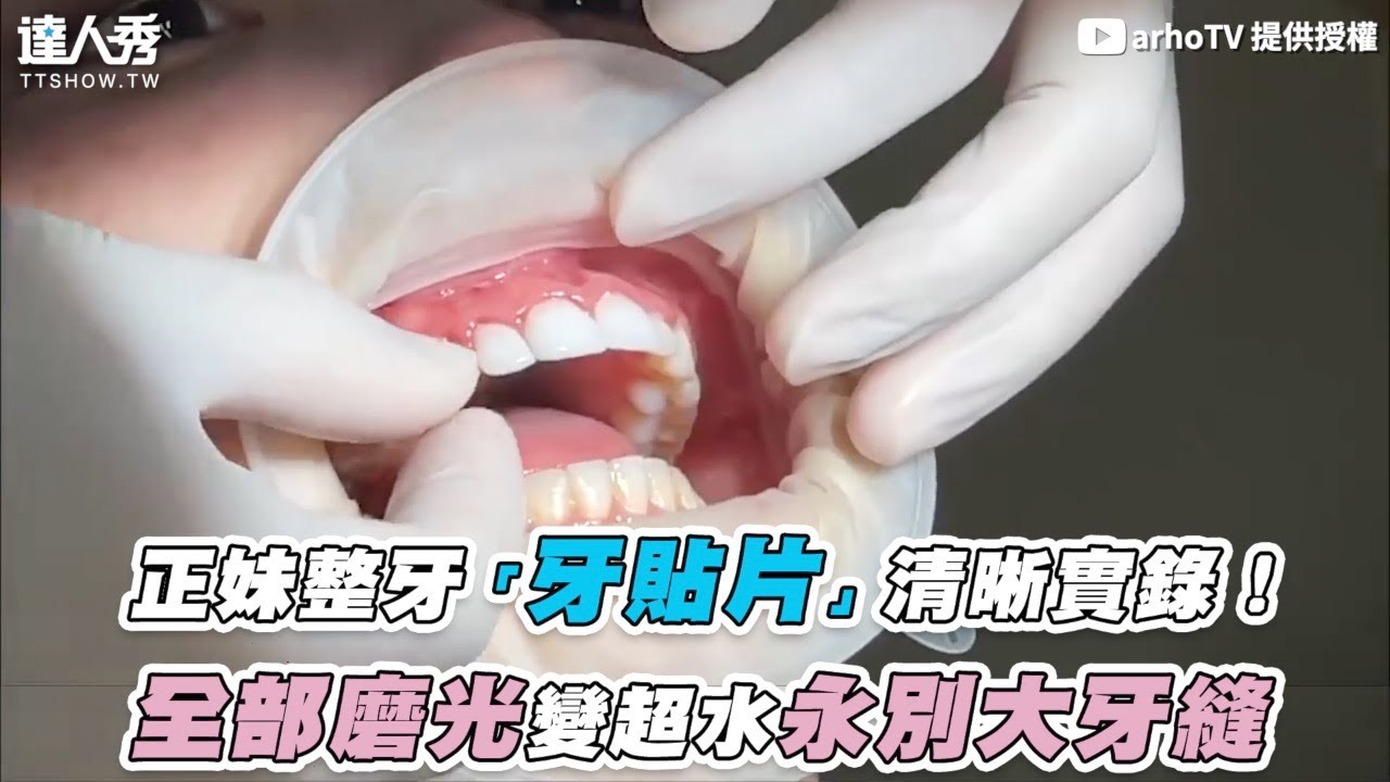 【正妹整牙「牙貼片」清晰實錄！ 全部磨光變超水永別大牙縫】｜@arhoTV