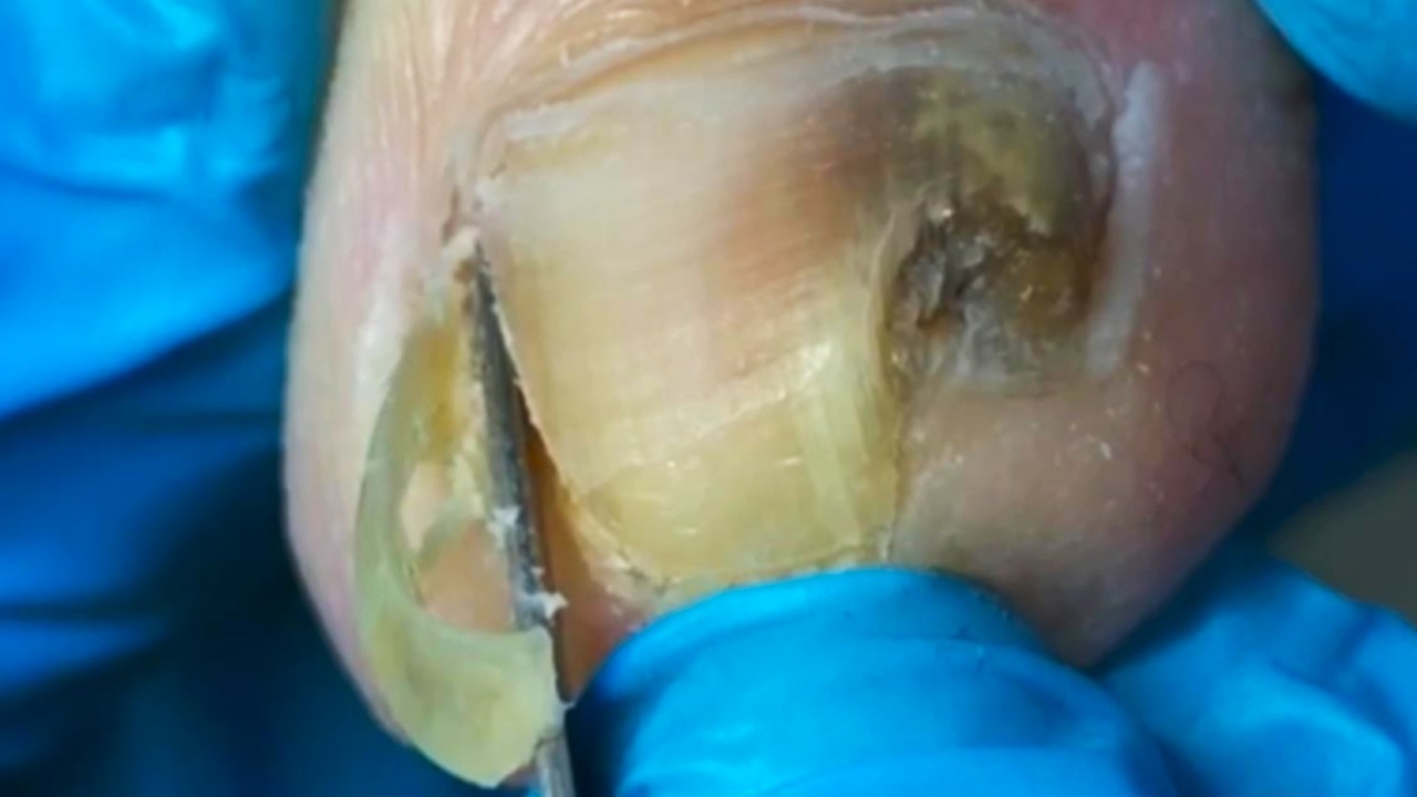 The Huge Ingrown Toenails And Onychomycosis Were Successfully Removed!【Crazy pedicure room】