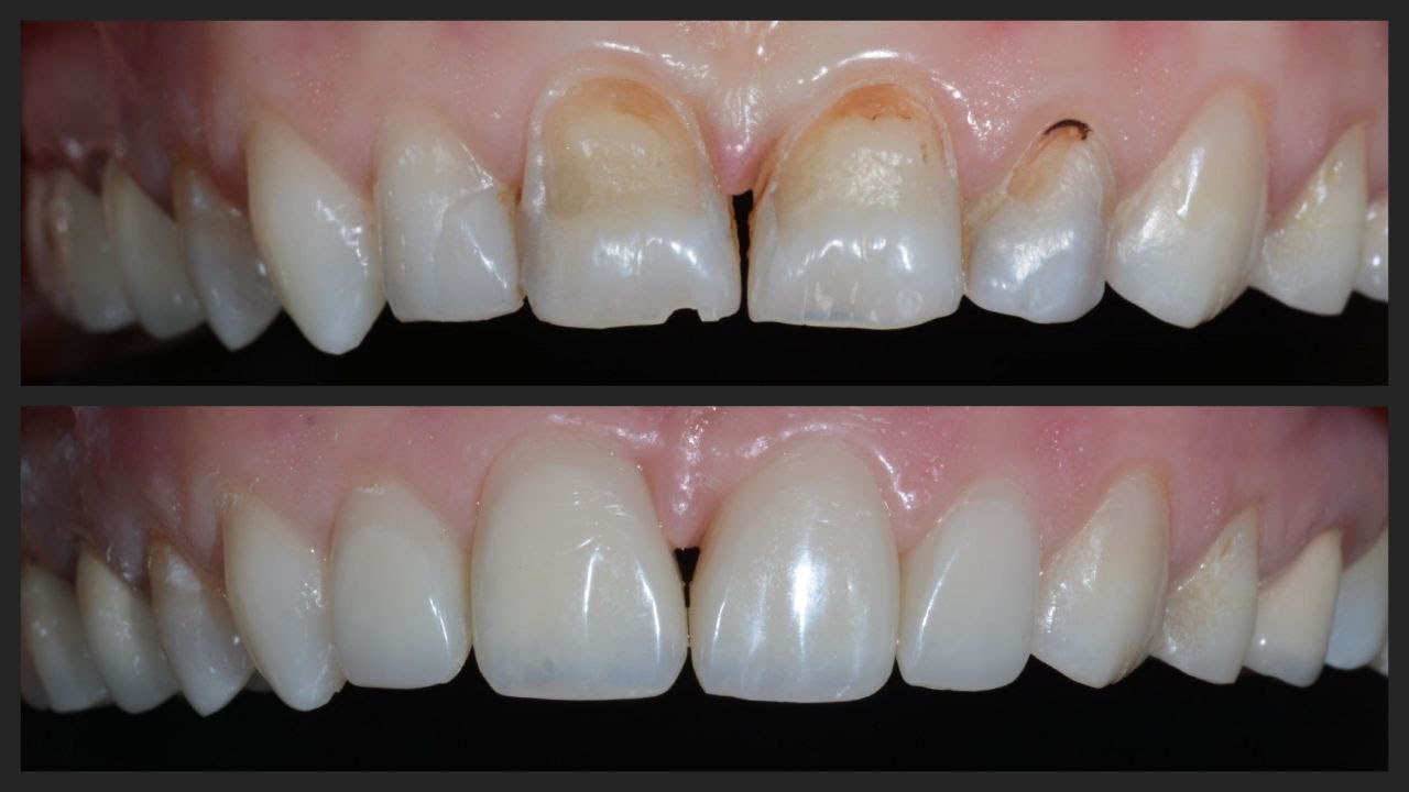 انهاء و تلميع كومبوزيت finishing and polishing for direct composite