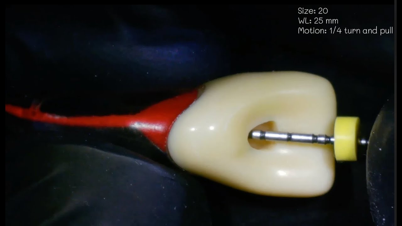 Root Canal Cleaning and shaping using Rotary files