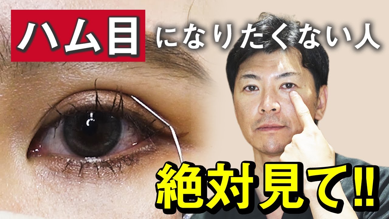 【二重整形】眠そうな「ハム目」の原因って？｜失敗する人の特徴とは？【水の森美容クリニック】