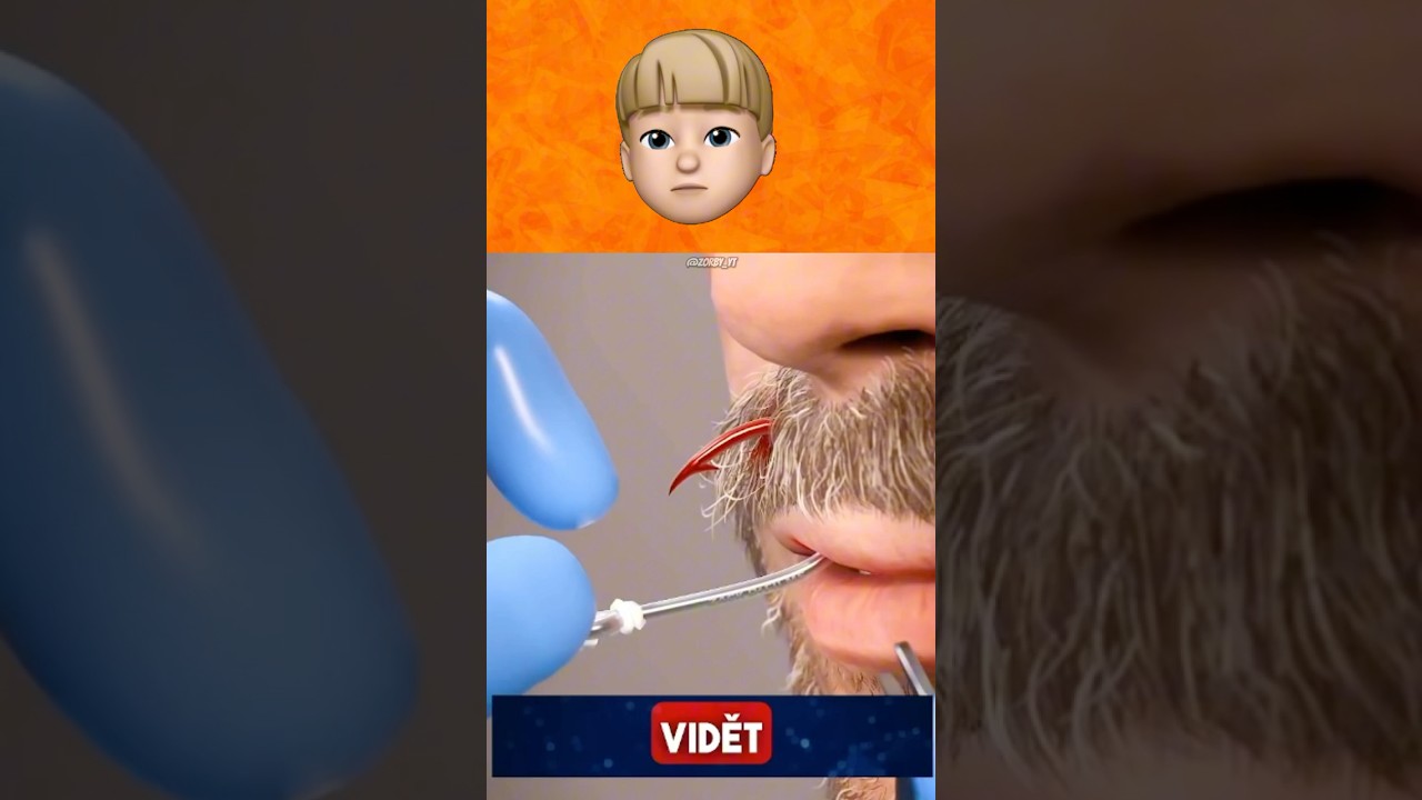 Ako vytiahnuť háčik z úst? 😮🎣