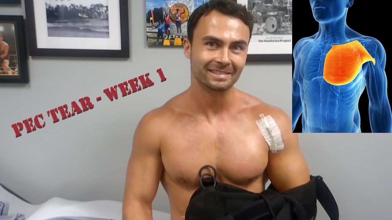 Pec Tear - Week 1