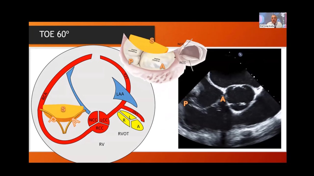 Expert TOE imaging of Tricuspid Valve with cases - Prof Greg Scalia and Prof David Muller