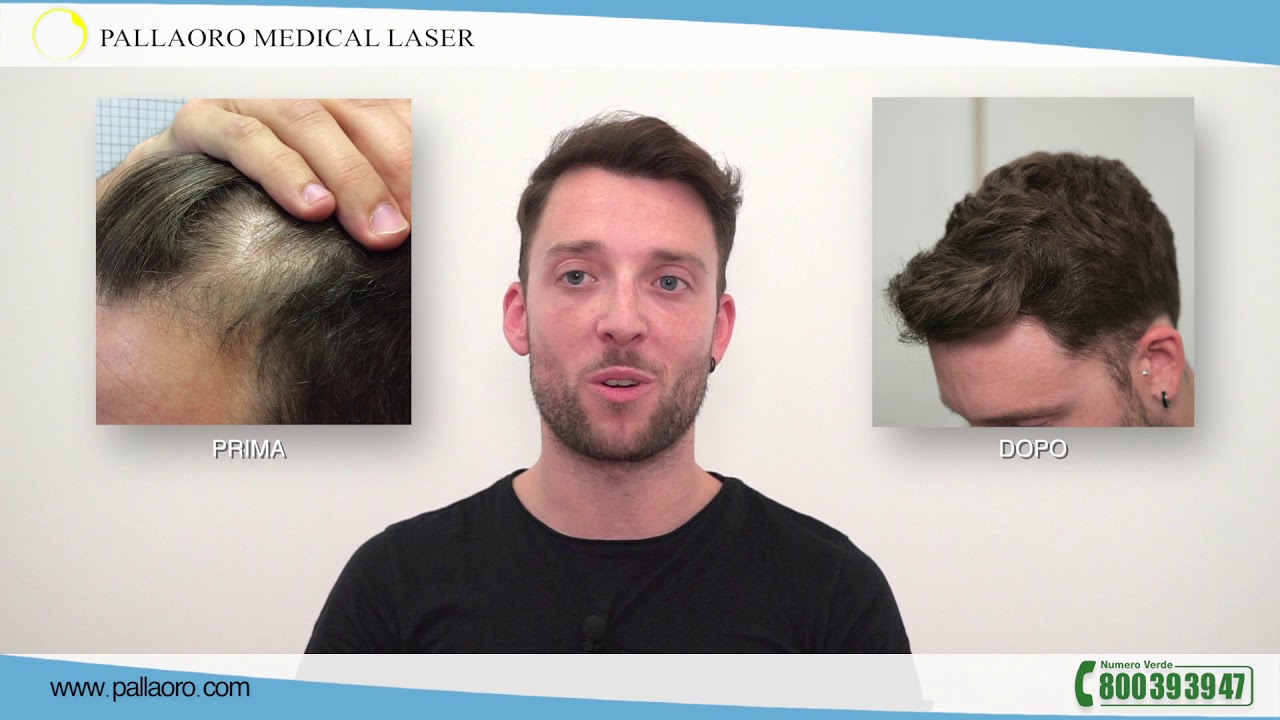 Trapianto capelli delle stempiature di Manuele
