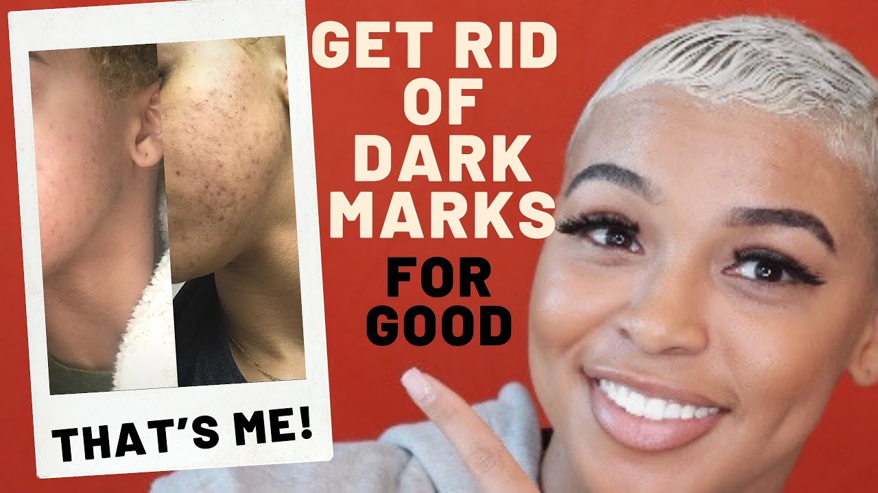 How To Get Rid Of Dark Spots + Hyperpigmentation | Black Girl Skin Care | Stubborn Dark Marks