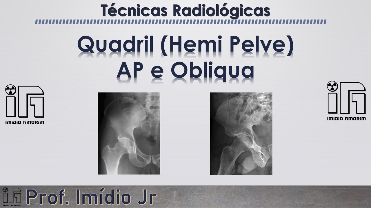 Quadril (Hemi Pelve) AP + Obliqua