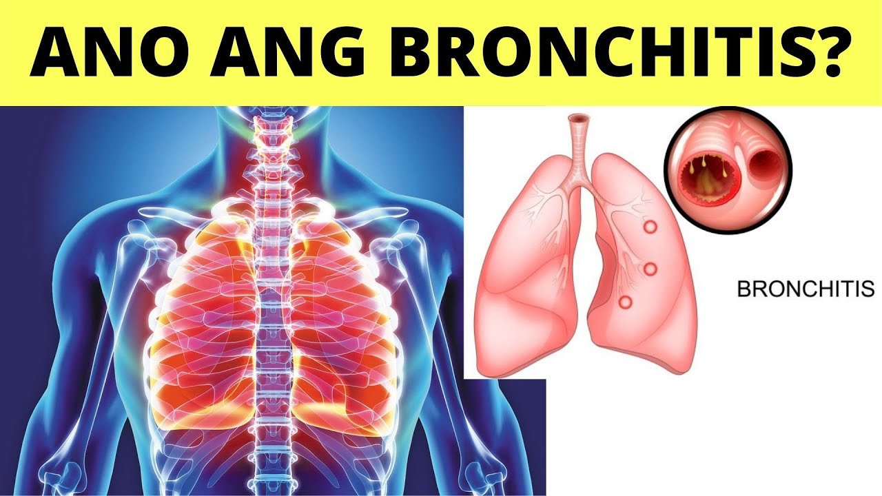 BRONCHITIS