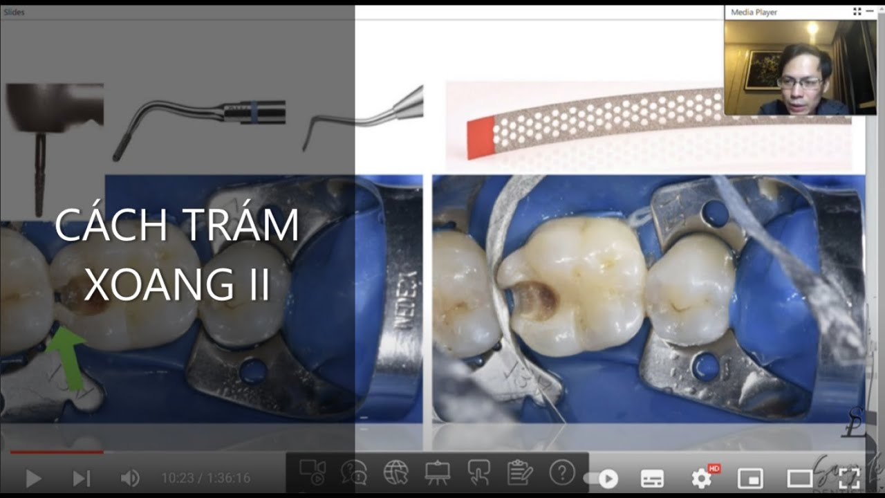 PHỤC HỒI XOANG II:THÁCH THỨC TRÊN LÂM SÀNG VÀ HƯỚNG GIẢI QUYẾT | BS. Phạm Minh Cường #3M