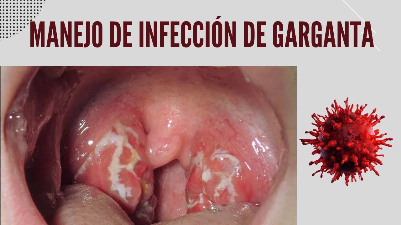 Manejo de la Infecci&oacute;n y dolor de garganta