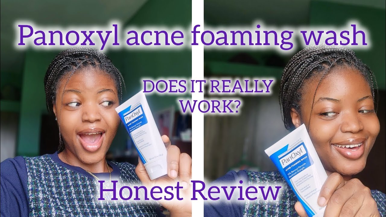 USE THIS IF YOU HAVE STUBBORN ACNE AND DARK SPOTS/ HONEST REVIEW ON PANOXYL ACNE CLEANSER