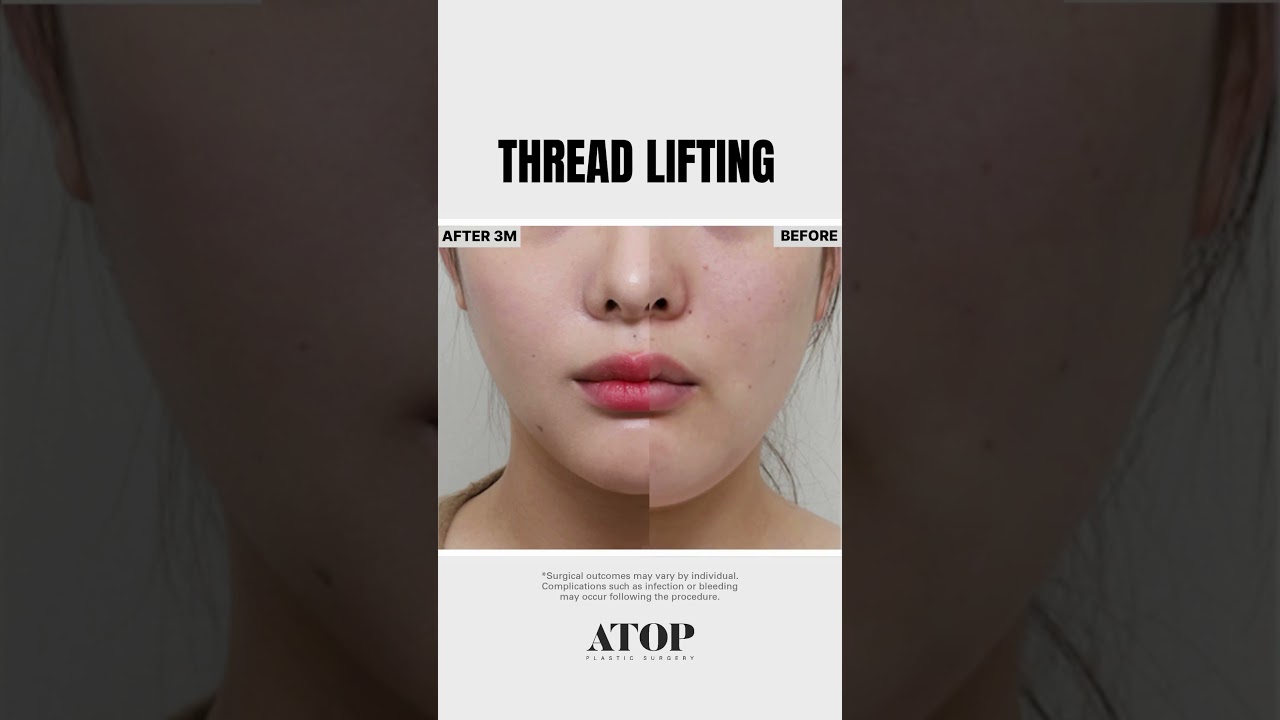 Thread Lifting at ATOP