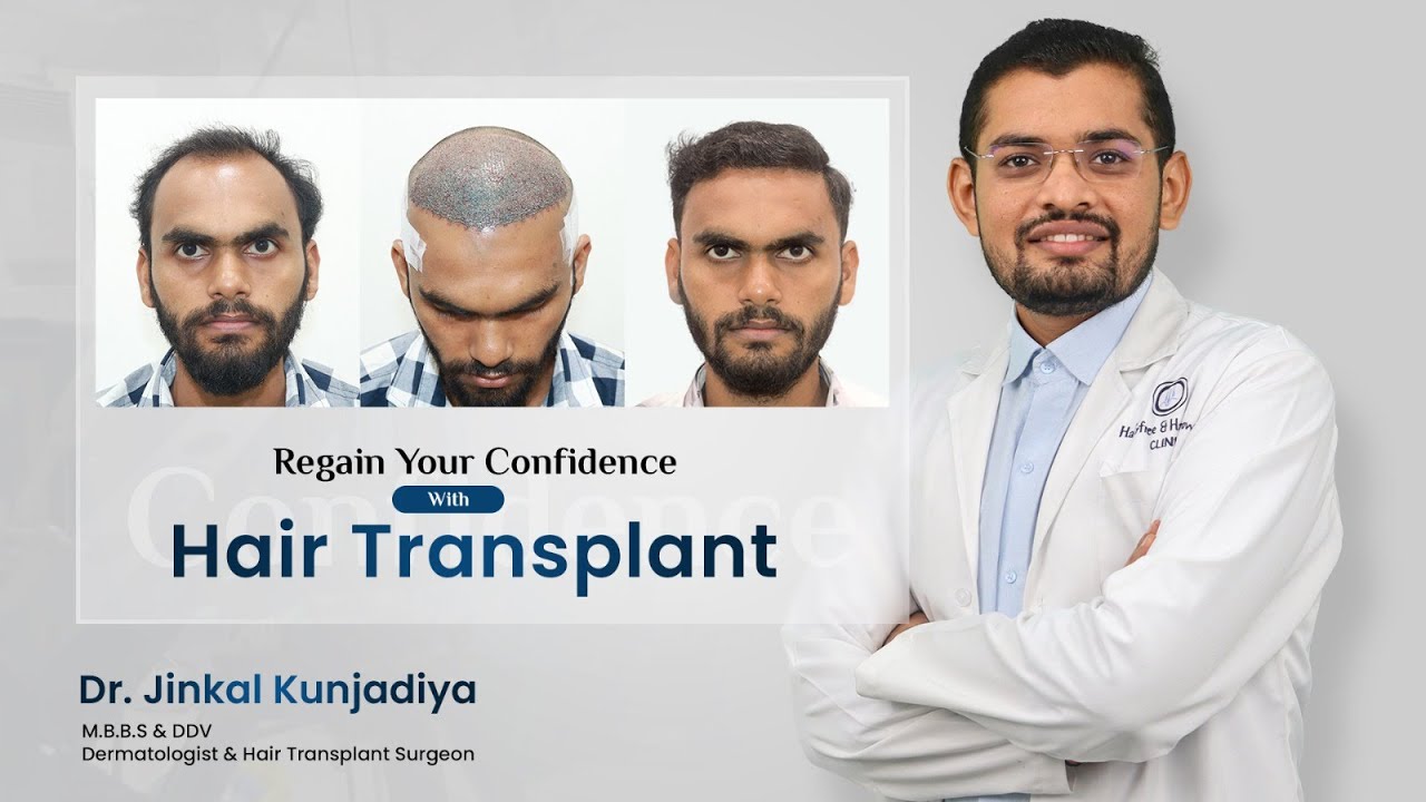Unlocking Confidence: Dr. Jinkal Kunjadiya Explains a 3800 Graft I-FUE Hair Transplant Journey