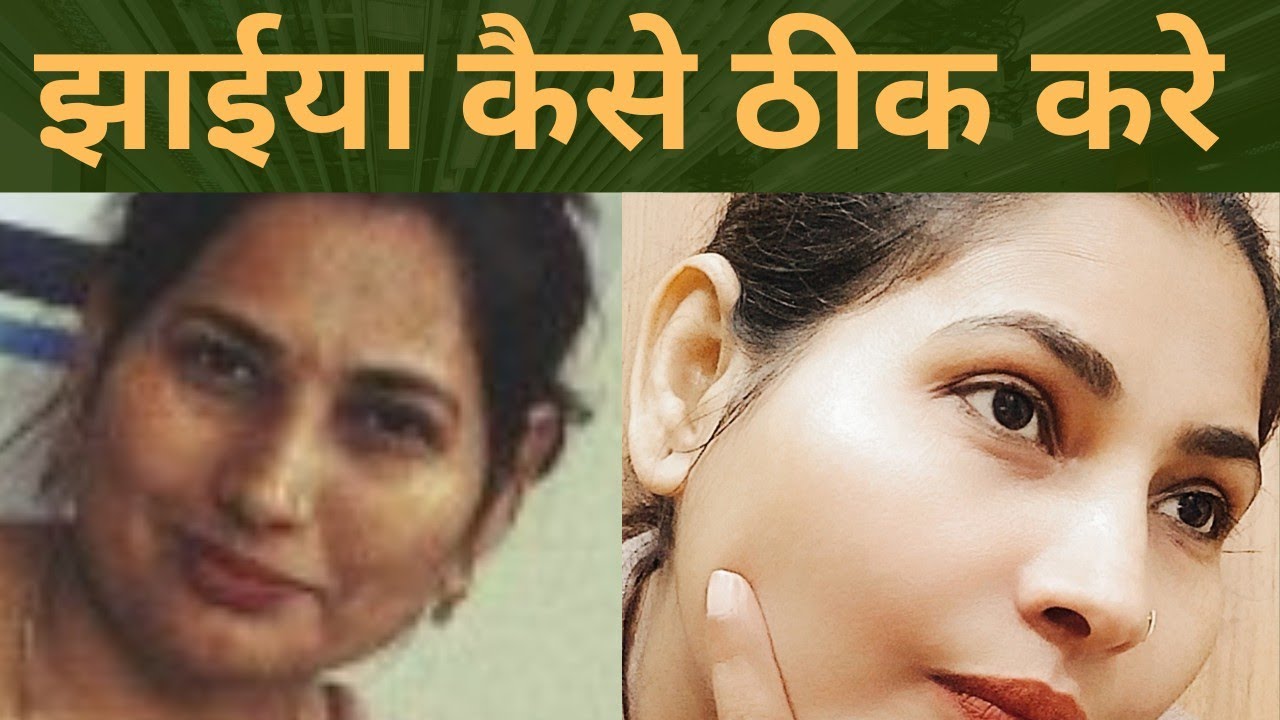 झाईया क्यों होती हैं और इसे कैसे ठीक करे। @vanshika ka corner