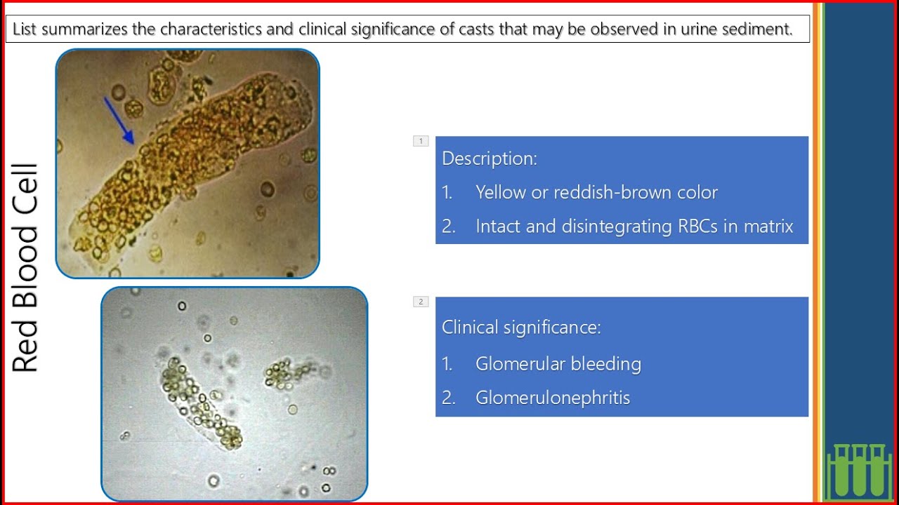 Urinalysis - Microscopic Urinalysis Part III Crystals and Casts (2025)