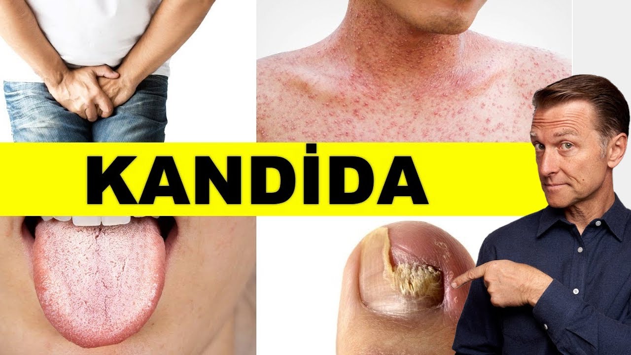 Kandida vücuttan nasıl atılır? | Dr.Berg Türkçe