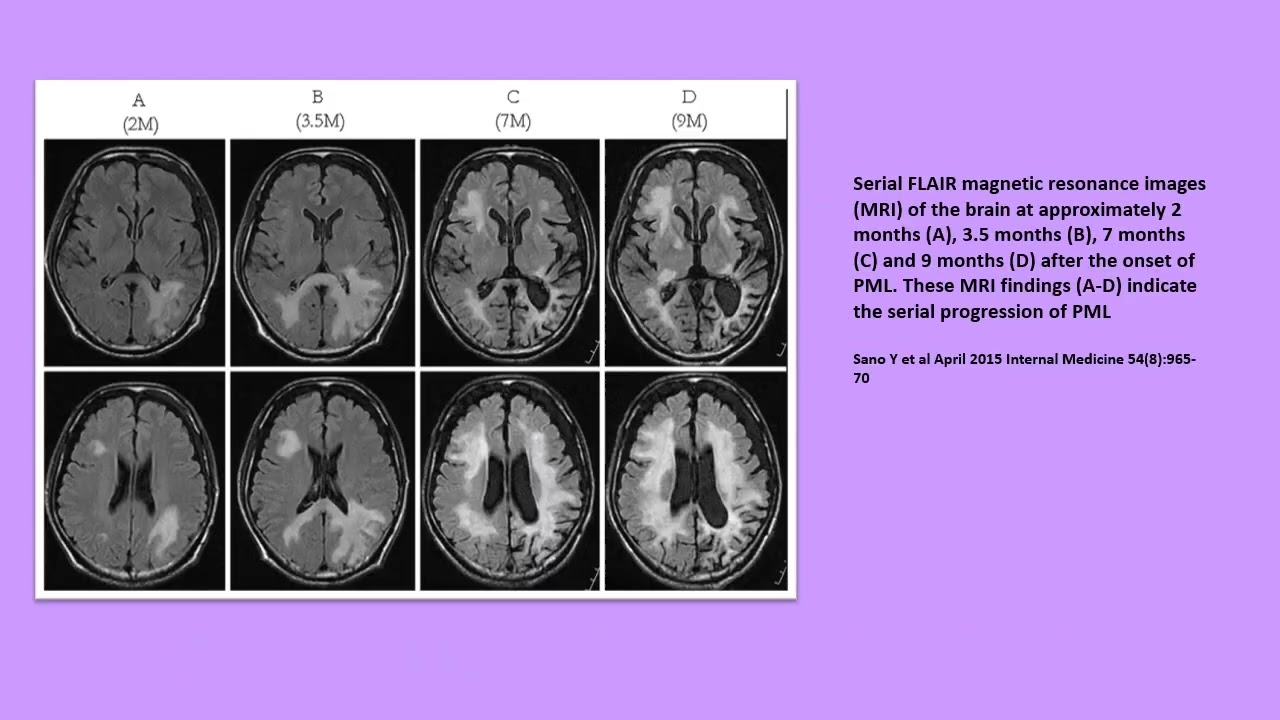 Neurology Quiz #95   Progressive multifocal leukoencephalopathy (PML)