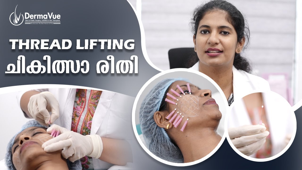 🌟 "Thread Lift Transformation: A Dermatology Marvel for Youthful Skin! ⚕️✨ 