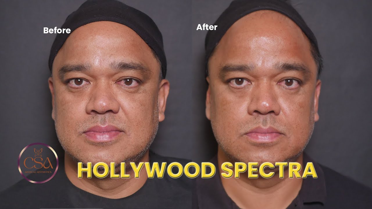 Anti aging and Anti pigmentation treatment using Hollywood Spectra