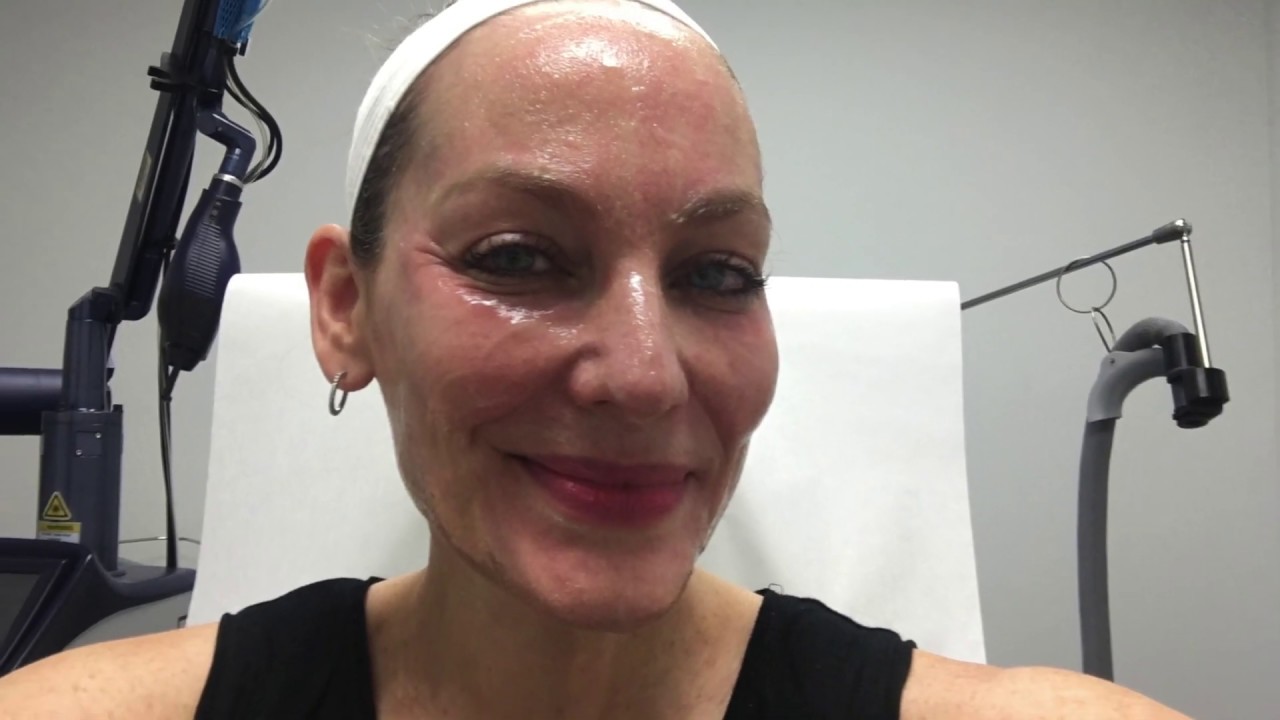 Fraxel lasers: Can you look five years younger in five days?