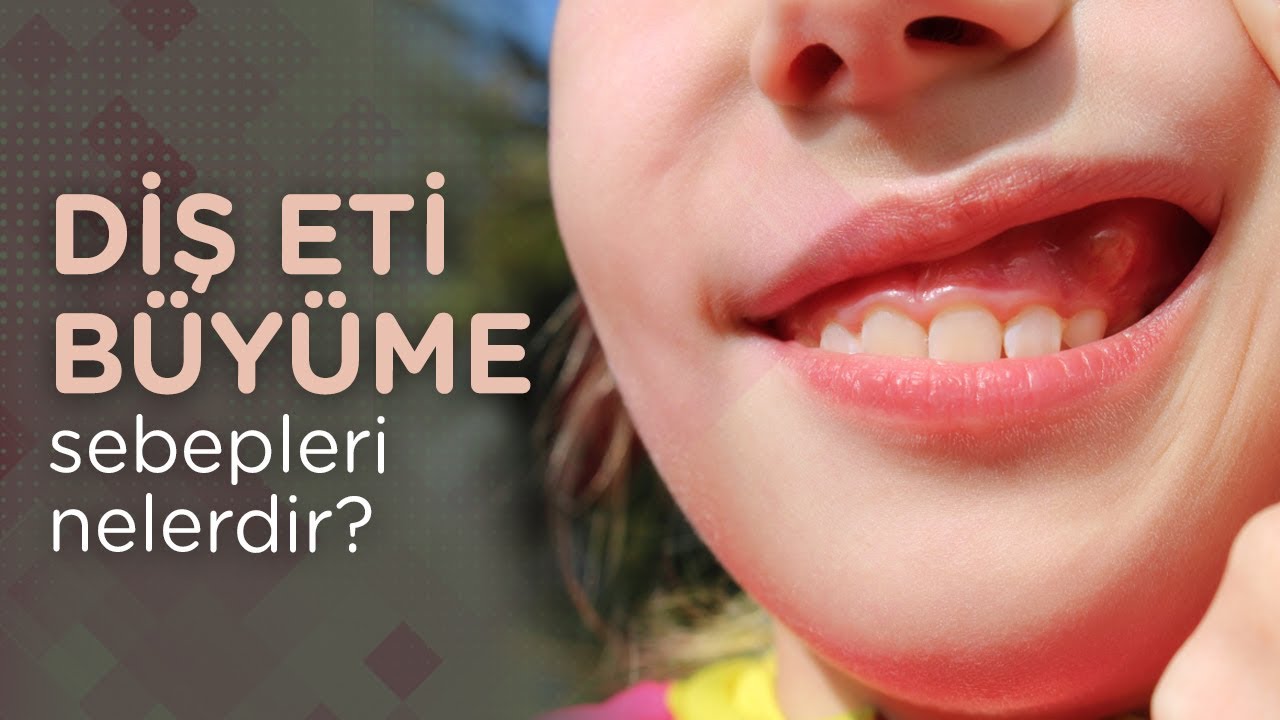Diş eti büyüme sebepleri nelerdir?