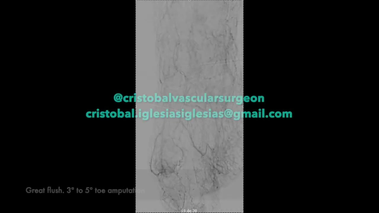Popliteal schokwave IVL & DEB Sirolumus 6x150mm + Tibial Angioplasty and partial arch recanalization